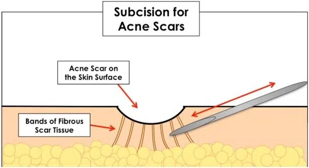 Cách trị sẹo mụn