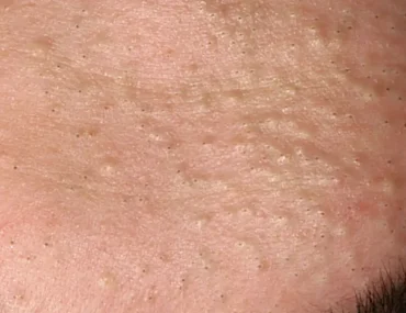 Cách trị mụn ẩn tại nhà