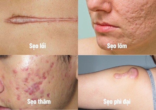 Cách trị sẹo mụn