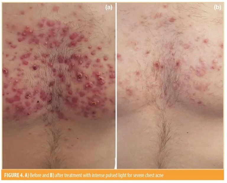 IPL cho mụn lưng ngực