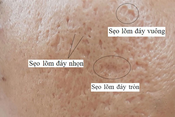 phân biệt sẹo rỗ thâm mụn và lỗ chân lông to